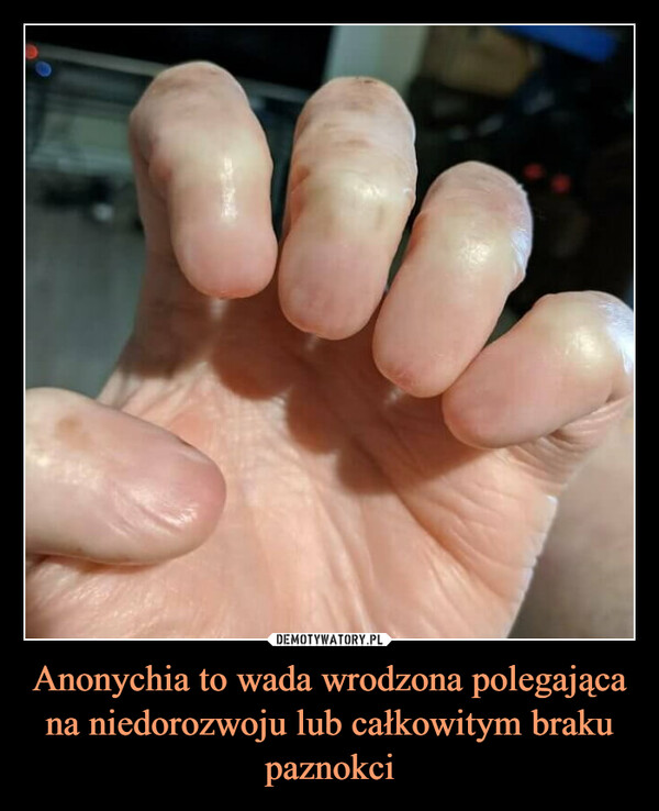 Anonychia to wada wrodzona polegająca na niedorozwoju lub całkowitym braku paznokci –  